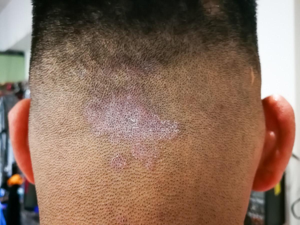 closed up of ringworm also known as tinea on he scalp of the hea